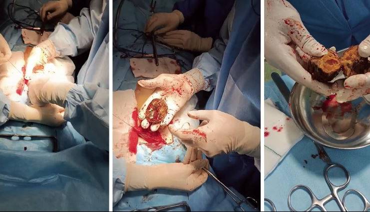 خطر پنهان خرمالو؛ بستری و جراحی بیماران در مشهد